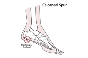 Evaluating Treatment Paths for Painful Heel Growths
