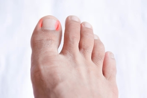 Managing Ingrown Toenails