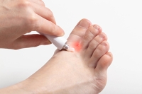 What Is Athlete’s Foot?