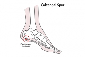 Bone Spurs on the Feet