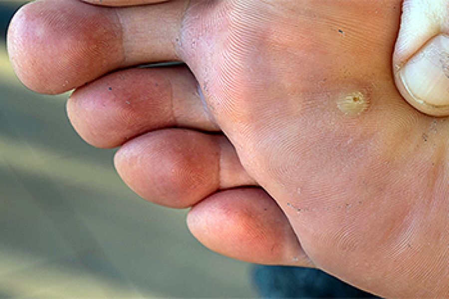 Painful plantar warts
