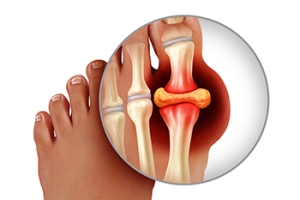 What You Need to Know About Gout
