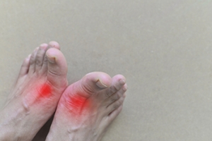 Living With Gout