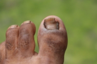 Causes of Toenail Fungus